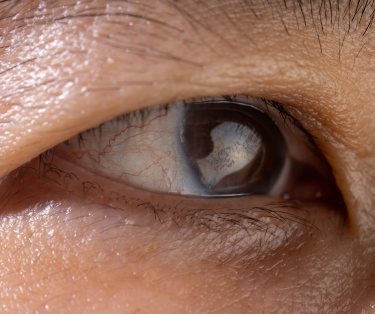 Upclose image of an eye with a cataract