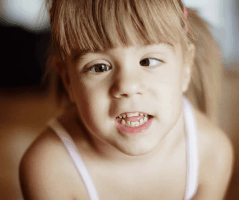 Close-up of a young girl showing visible signs of strabismus with her eyes turning in different directions.