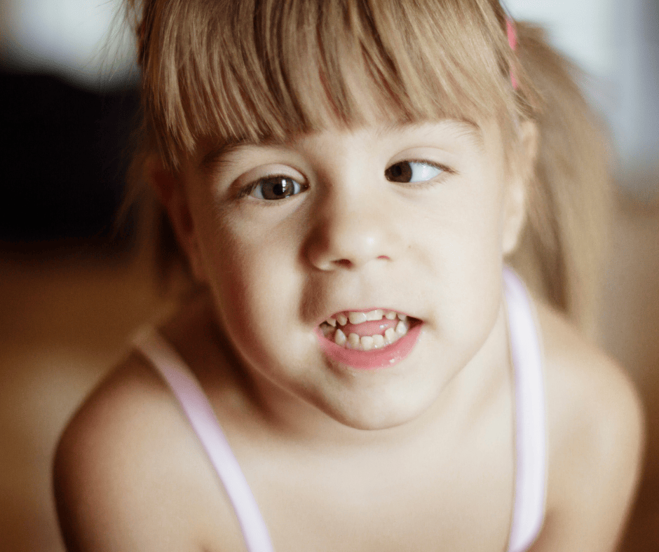 Close-up of a young girl showing visible signs of strabismus with her eyes turning in different directions.