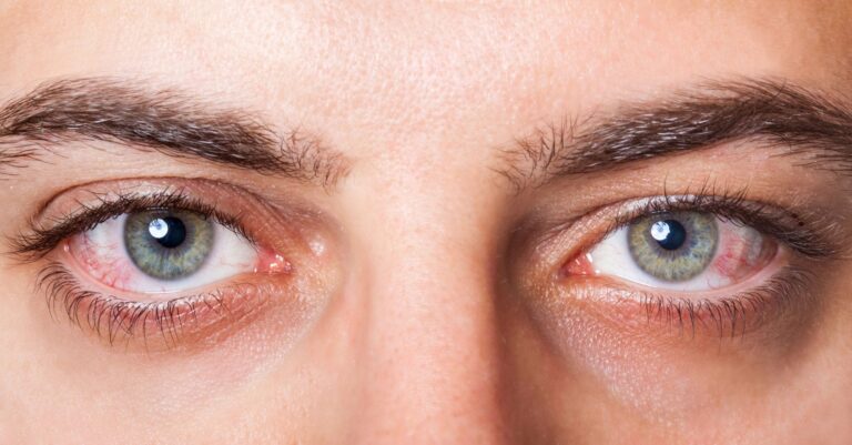photo of person showing a close up of dry, red eyes