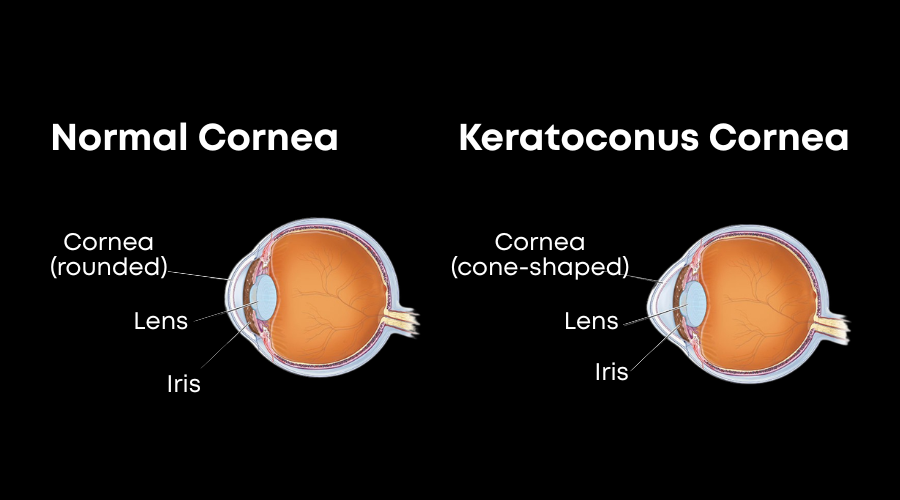 Diagram comparing a normal rounded cornea with a keratoconus cone-shaped cornea, showing the cornea, lens, and iris in cross-section.