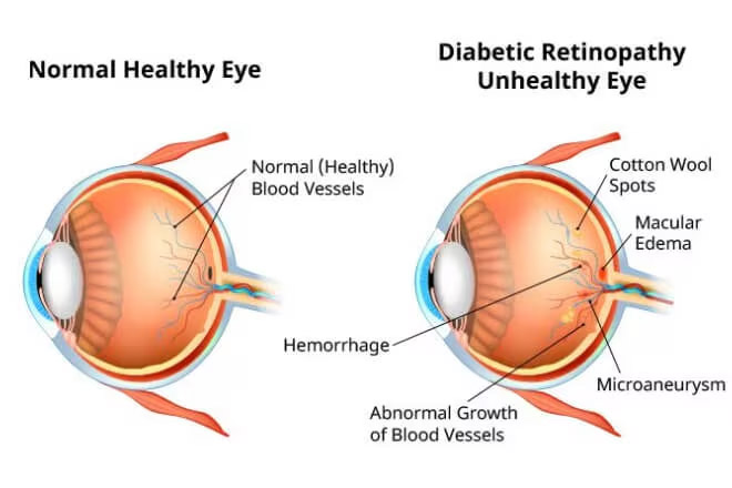Illustration showing a normal eye scan and an eye scan of diabetic retinopathy.