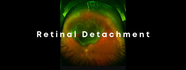 An image of an eye illuminated showing retinal detachment.